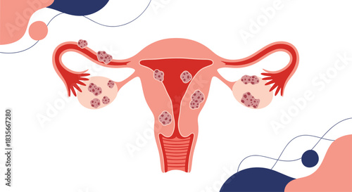 Medical illustration of the female reproductive system showing conditions like endometriosis or uterine fibroids affecting the uterus.