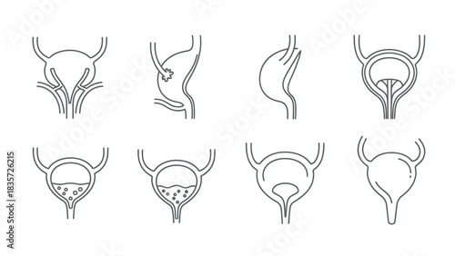 Anatomical Illustrations of Bladder Conditions and Variations in Medical Schematic Style
