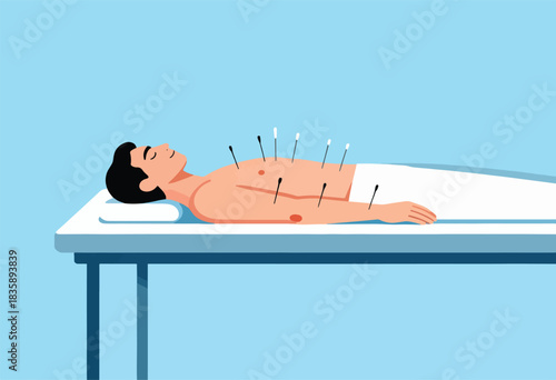 Illustration of a person lying on a table, undergoing acupuncture treatment. Needles are inserted in the body