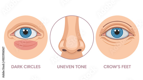 Illustration of common skin imperfections dark circles uneven tone and crows feet vector diagram for dermatology and skincare education