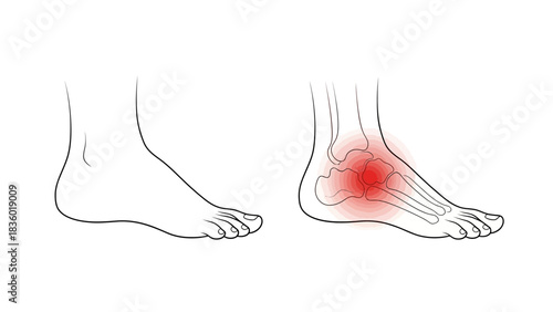 Illustration of a healthy foot next to a foot with highlighted pain in the arch and heel, symbolizing foot discomfort or injury