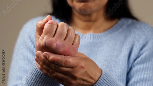 Woman Examining Her Hands, Showing Skin Issues, Inflamed Fingers, Hand Pain Concept