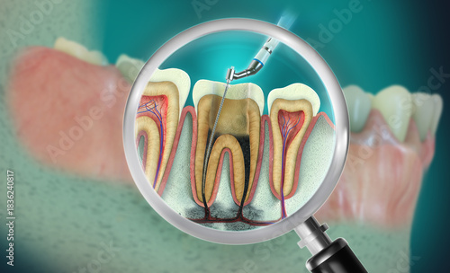 3D illustration of Endodontic root canal treatment. An advanced endodontic file is in action. It removes the infected enamel, dentin and some parts of the pulp tissue. 