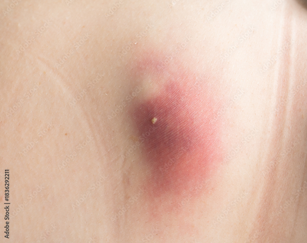 Fototapeta premium Macro close-up image of an inflamed boil filled with pus on human skin. Skin infection showing redness, swelling, and abscess. Medical dermatology condition.