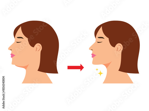 Double chin woman with drooping second chin, plastic surgery