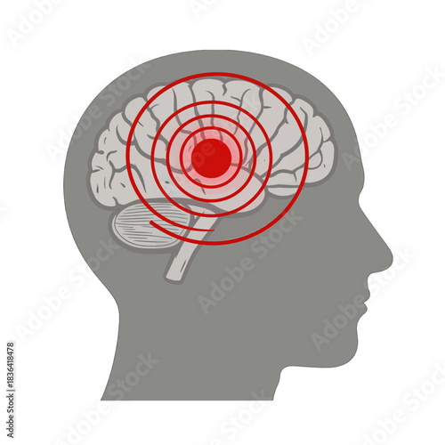Brain Injury Headache Vector Illustration