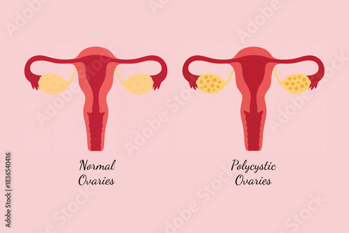 Comparison Diagram of Normal Ovaries and Polycystic Ovaries (PCOS) in the Female Reproductive System