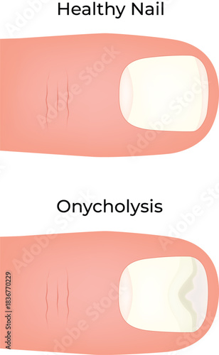 Comparison of Healthy Nail vs. Onycholysis (Nail Separation) Vector Illustration