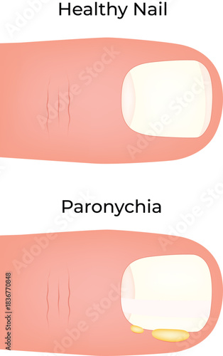 Paronychia Nail Infection Comparison Vector Illustration