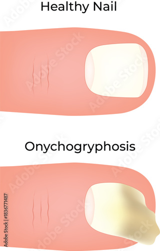 Healthy Nail vs Onychogryphosis A Visual Comparison Vector illustration