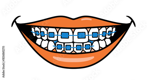 Smiling mouth with blue orthodontic braces on teeth