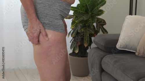 An overweight woman in her underwear examines and touches her back thighs. Cellulite, lipedema, stretch marks, veins, buttock folds. Body positivity, obesity, weight loss, liposuction, diet.