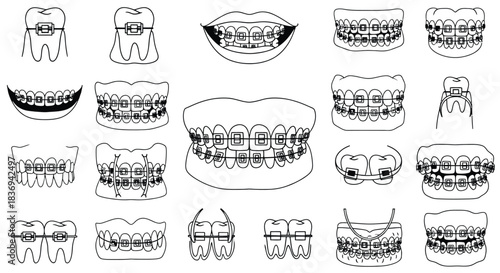 Various dental braces and orthodontic treatments for teeth alignment