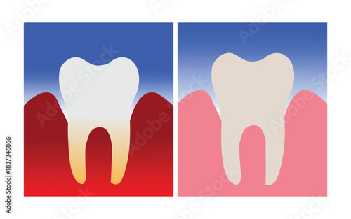 Comparison of healthy and diseased gums surrounding a tooth