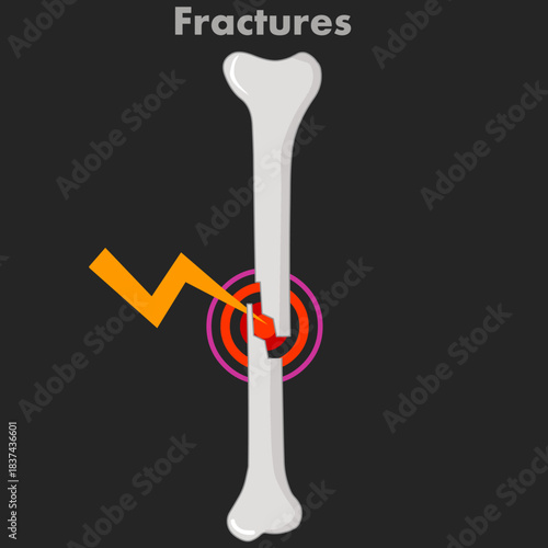 Fracture refers to a broken bone, bones can break completely. Dark X-ray. Leg, arm roentgen sample. Medical vector Illustration