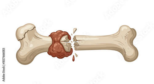 Medical illustration showing a severe bone fracture with an open wound and bleeding representing a serious orthopedic injury.