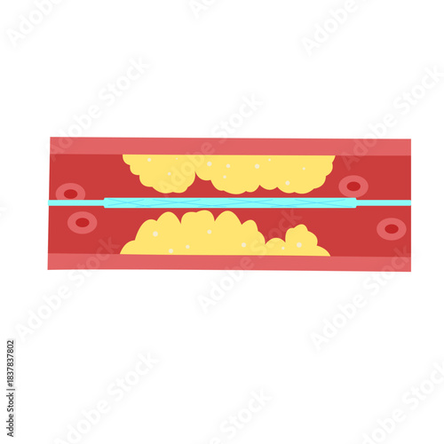 Cholesterol Buildup in Blood Vessel concept