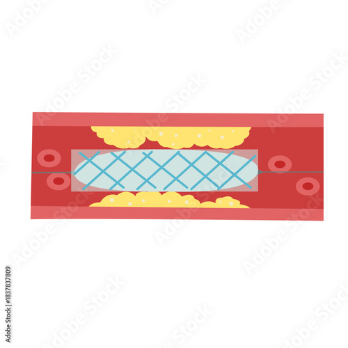 Cholesterol Buildup in Blood Vessel concept