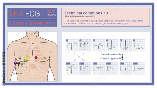 The right chest lead is to place a chest lead electrode on the right chest, which is the mirror image of the left chest lead, and is used to explore the right ventricular electrocardiogram.
