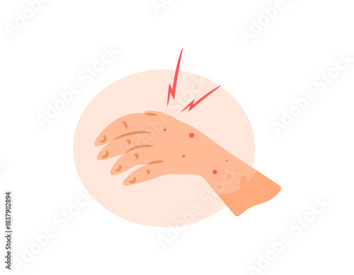 Illustration of an itchy hand with red spots. Red bumps appear on the hand. Symptoms of allergies or chickenpox. Health problems and skin diseases. Flat design style. White background.