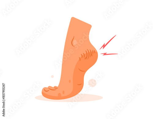 Illustration of dry, cracked or chapped feet. Cracked feet are caused by dry skin. Health problems and skin diseases. Flat design style. White background.