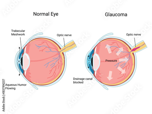 Glaucoma. Human Eye anatomy. Intraocular pressure.  Vision loss. Diagram for education and medical use.  Vector illustration
