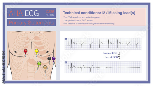 When the leads of the electrocardiogram fall off, most often in the chest leads, the ECG waves in that lead may suddenly disappear. Do not misdiagnose this as cardiac arrest.

