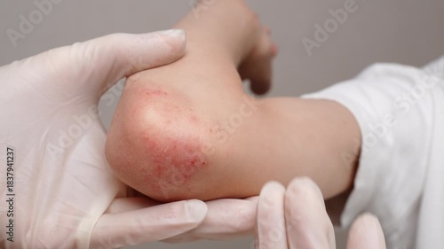 Dermatologist examines reddened, itchy areas with rash on child's elbow, close-up. Child suffers from allergic reactions and dermatitis. Concept of pediatric dermatological skin diseases and treatment