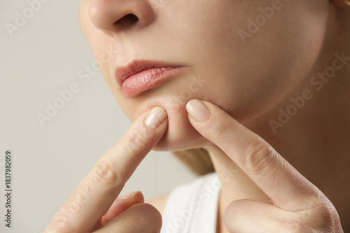 Young woman with a pimple on a chin. Inflamed acne and post-acne marks, redness. Hormonal adult acne.	