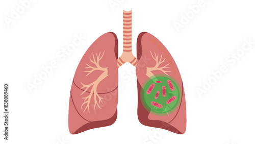 Anatomical Illustration of Human Lungs with Bacteria Infection in Green Highlighted Area Showing Microscopic Organisms in Trachea Branching Structures on Black Background Medical Healthcare Concept