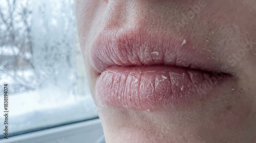 Cracked lips from cold weather with snow in the background  