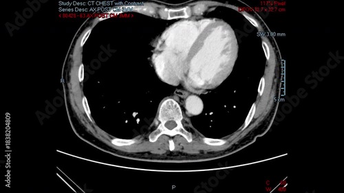 Chest CT scan of a male patient showing the spread of thymus cancer, the cause of Myasthenia Gravis.