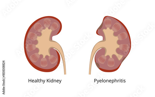 Healthy kidney and kidney with pyelonephritis, comparison and anatomy