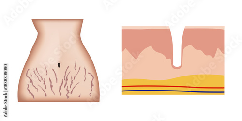 Woman abdomen showing stretch marks and detailed skin anatomy