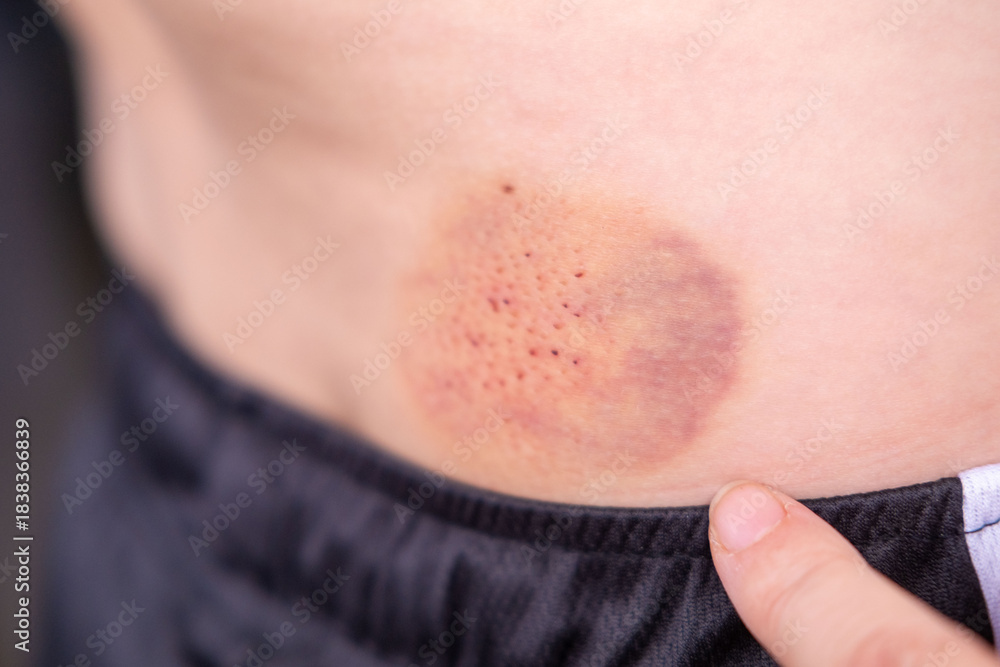 Fototapeta premium little boy holds sore side, human skin with large red and prominent purple bruise, lower back or hip area, showing discoloration from injury, Medical condition, childhood safety