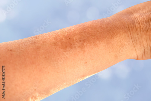 Close-up mature woman’s hand with age spots and pigmentation, showing signs of melanin overproduction, aging skin, and natural changes, skincare and health concept, hyperpigmentation