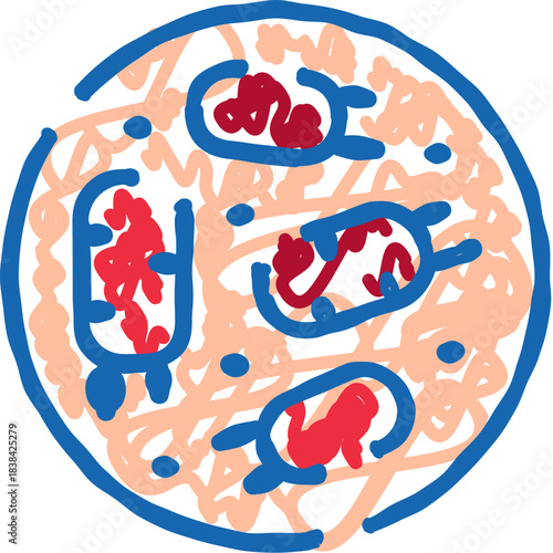 Blood clot forming in human artery causing thrombosis