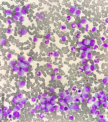 Chronic myeloid leukemia cells or CML, analyze by microscope