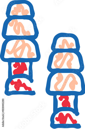 Spinal column diagram with healthy and inflamed discs