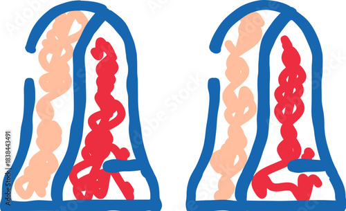Human tonsil anatomy showing infection and inflammation