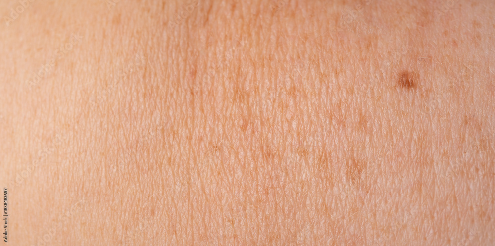 Fototapeta premium Skin mole spot closeup. Human birthmark, nevus macro texture