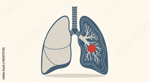 Illustration of human lungs with a red tumor in one lung, symbolizing lung cancer, respiratory disease, and health concerns