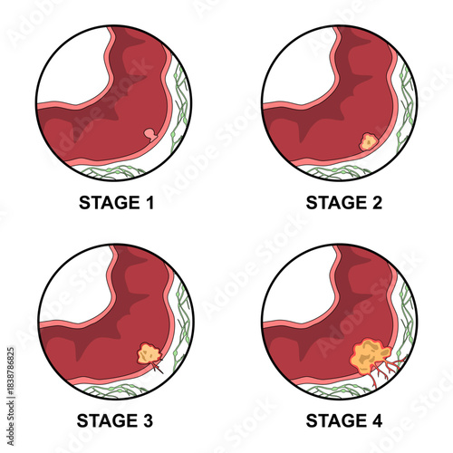 Illustration of colorectal cancer stages. Concept of colon cancer progression. Spread of tumor to lymph nodes. Medical vector illustration for clinics, education, and science.