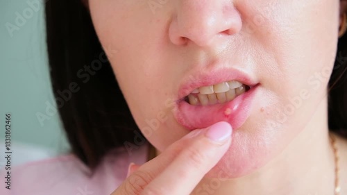 A woman has stomatitis on her lip
