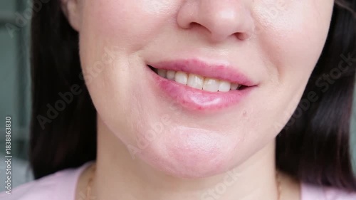 Women's lips on the second day after the introduction of hyaluronic acid, lip healing after enlargement
