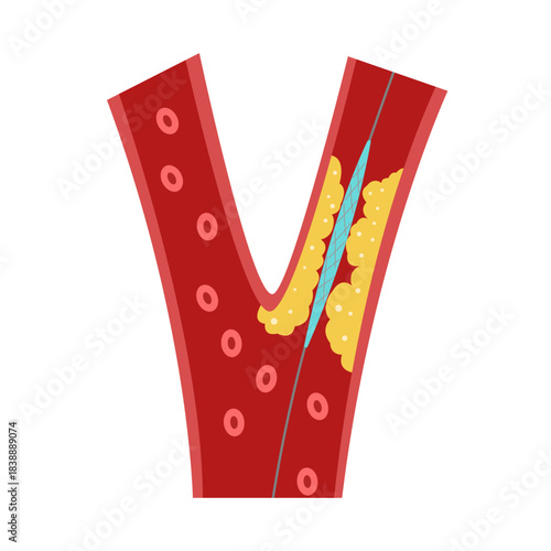 Balloon Angioplasty concept. vector illustration
