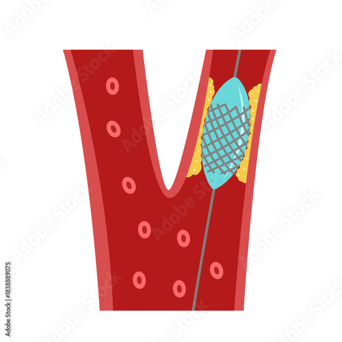 Balloon Angioplasty concept. vector illustration