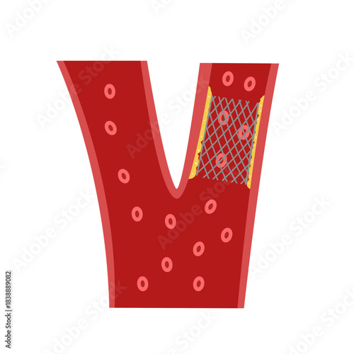 Balloon Angioplasty concept. vector illustration