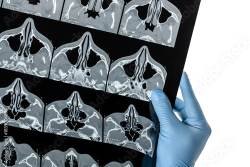 Hand in blue medical glove holds at CT examination of the paranasal sinuses xray film contrast image