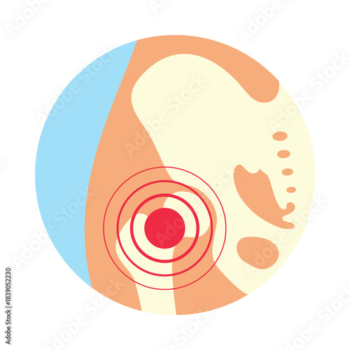 An illustration of hip osteoarthritis, with red circles clearly highlighting the painful area. This icon demonstrates an understanding of hip health.